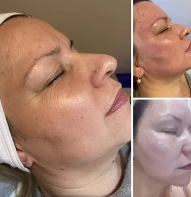 Microneedling 2